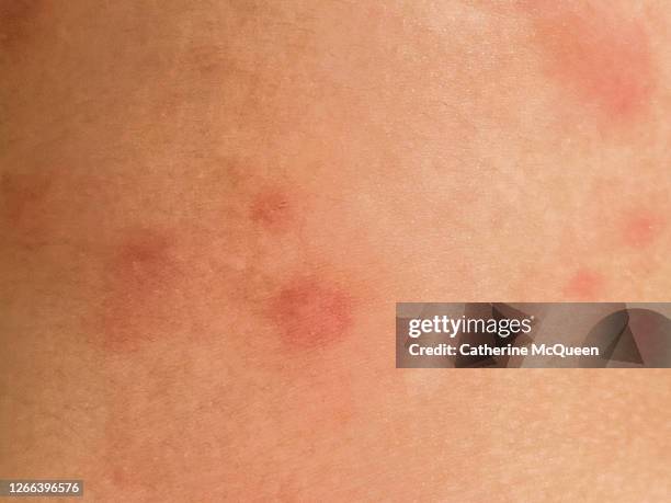 swollen & red mosquito bites on unrecognizable female’s leg - insect bites images stock pictures, royalty-free photos & images