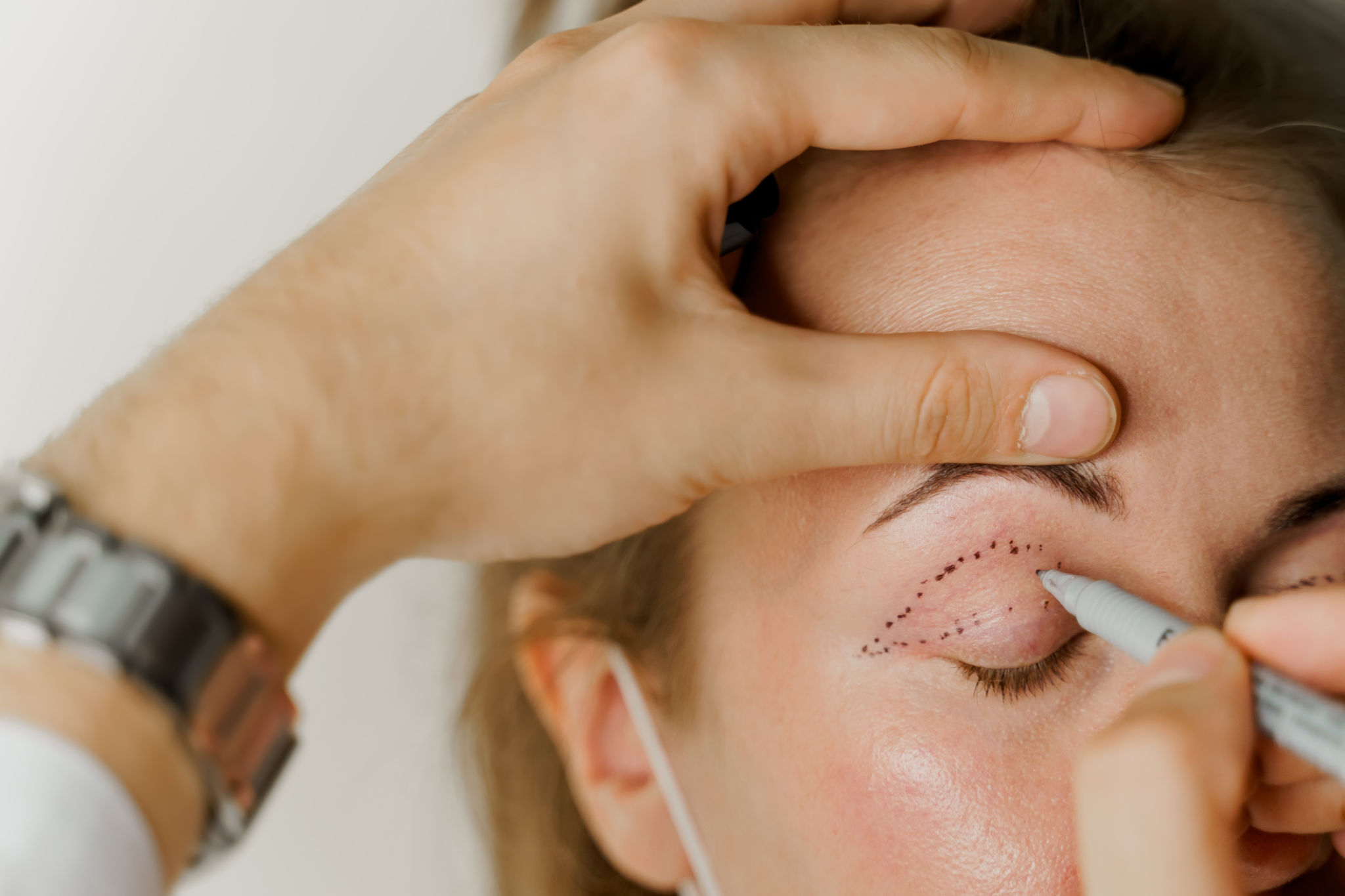 Marcação blefaroplastia de close-up no rosto antes da operação de cirurgia plástica para modificar a região ocular do rosto em clínica médica. 2 médicos fazem operação estética plástica Marcação blefaroplastia de close-up no rosto antes da operação de cirurgia plástica para modificar a região ocular do rosto em clínica médica. 2 médicos fazem operação estética plástica
