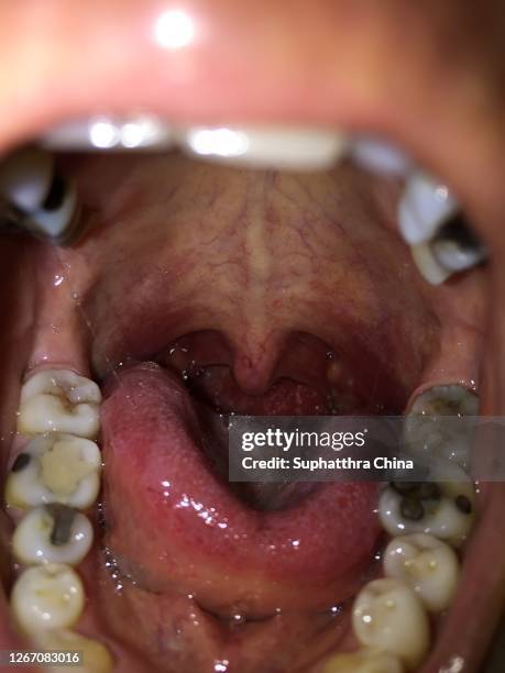 tonsilitis infection throat - faringe - fotografias e filmes do acervo