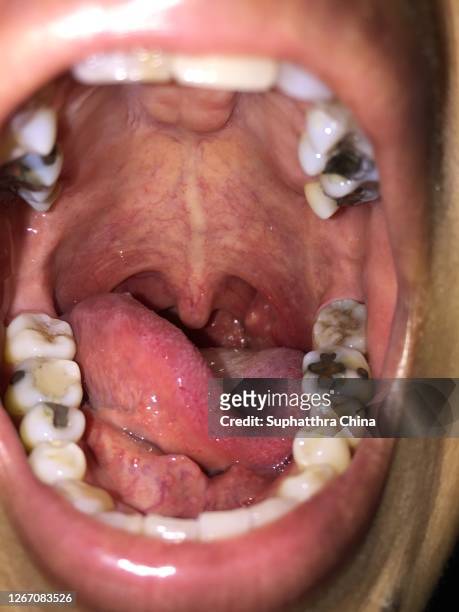 tonsilitis infection throat - faringe - fotografias e filmes do acervo