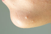 Close-up of Molluscum Contagiosum also called water wart. Viral formations in the chin on the skin of the child.