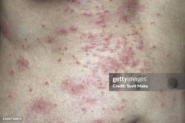 itchy rash - psoriasis skin stock pictures, royalty-free photos & images