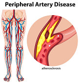 Medical peripheral artery disease