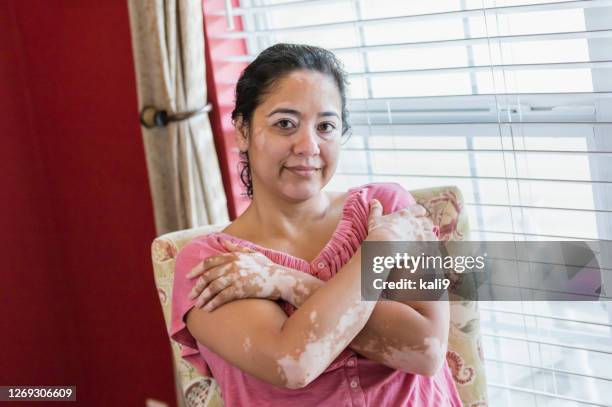 reife misch-rasse frau mit vitiligo - vitiligo stock-fotos und bilder