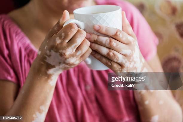rijpe gemengde-rasvrouw met vitiligo, die koffie drinkt - mottled skin stockfoto's en -beelden