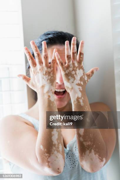 rijpe gemengde-rasvrouw met vitiligo - mottled skin stockfoto's en -beelden