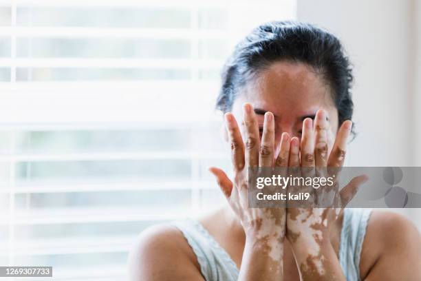 rijpe gemengde-rasvrouw met vitiligo - mottled skin stockfoto's en -beelden