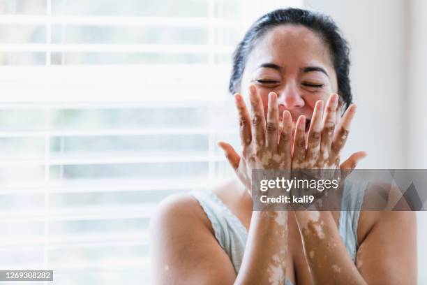 mature mixed-race woman with vitiligo - vitiligo stock pictures, royalty-free photos & images