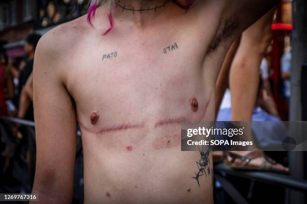 Protester with the scars of mastectomy seen along Bravo Murillo street during the demonstration. Different groups have demonstrated in the Tetuán...