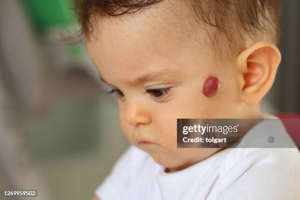 hemangioma en la cara de un bebé - hemangioma fotografías e imágenes de stock