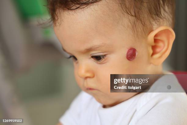 hemangioma on the face of a baby - endothelial function stock pictures, royalty-free photos & images