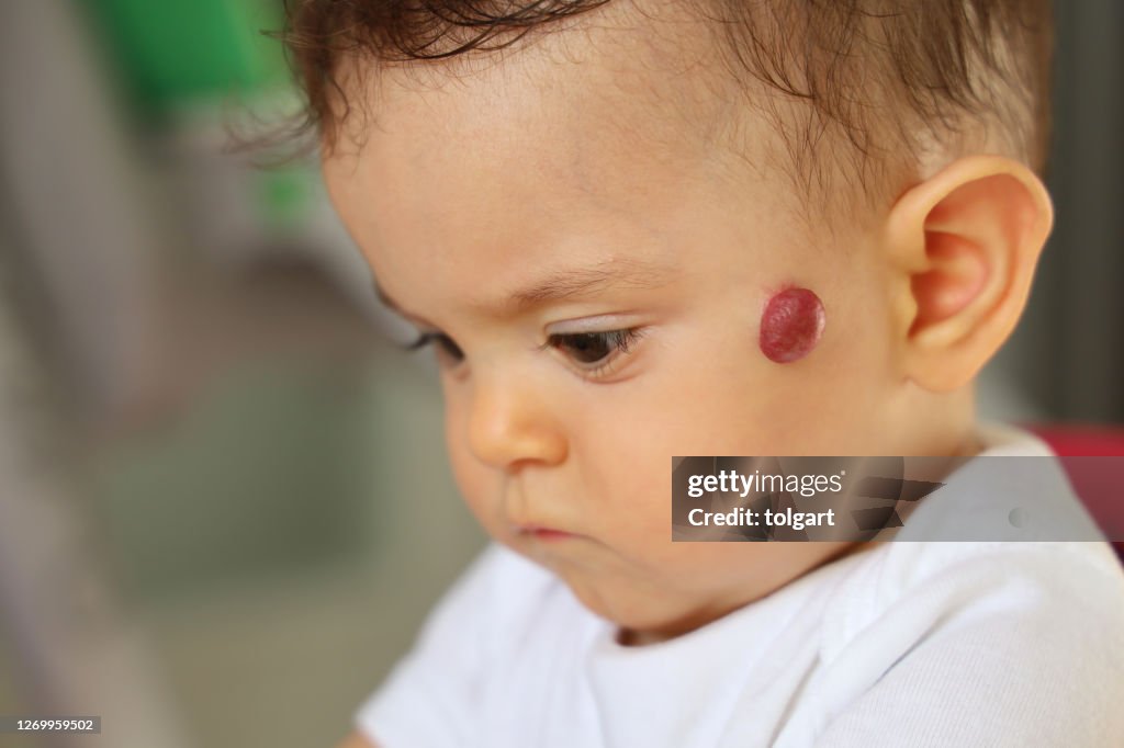 Hemangioma i ansiktet på en baby