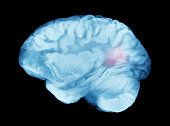 Brain Cerebral Aneurysms Causing Hemorrhagic Stroke or Paralysis