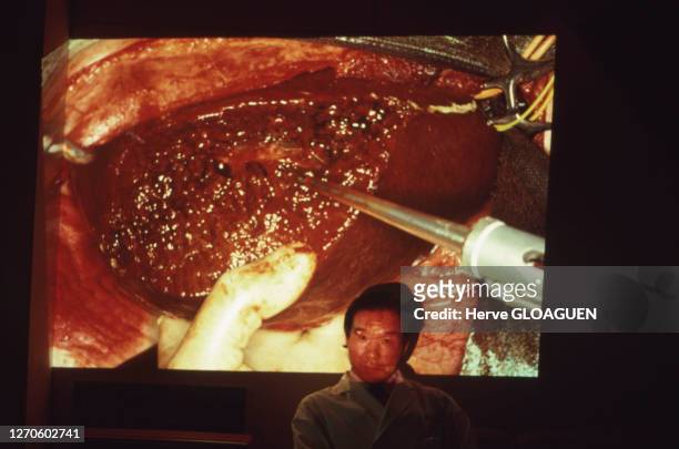 Le professeur japonais Yamasaki, an arrière plan sur un écran est projeté une opération chirurgicale au National Cancer Center Hospital en avril...