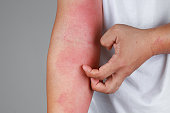 Eczema allergy skin, atopic dermatitis.