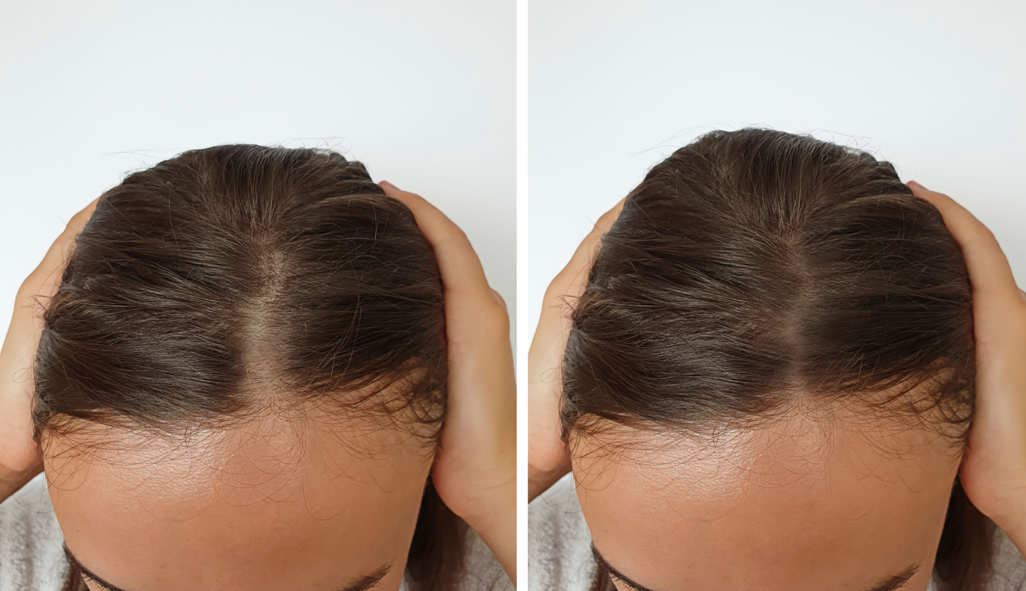 hair transplant women