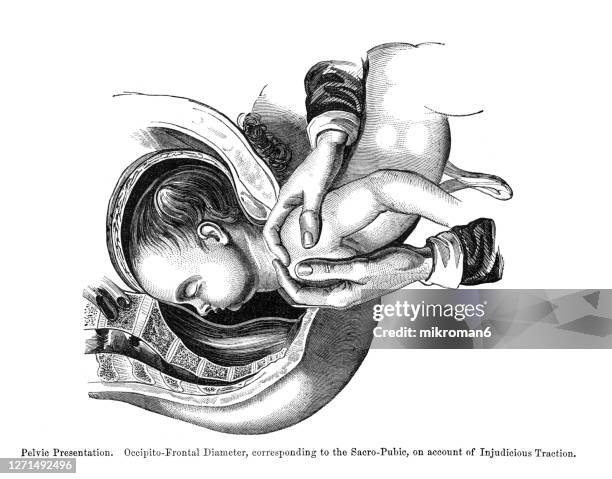 old engraved illustration of different positions of the fetus in womb - position du foetus photos et images de collection
