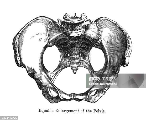 old engraved illustration of equable enlargement of the pelvis - biomedical illustration stock pictures, royalty-free photos & images