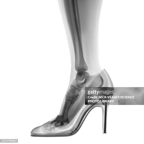 skeleton foot in high heel shoe, x-ray - human foot anatomy stock pictures, royalty-free photos & images