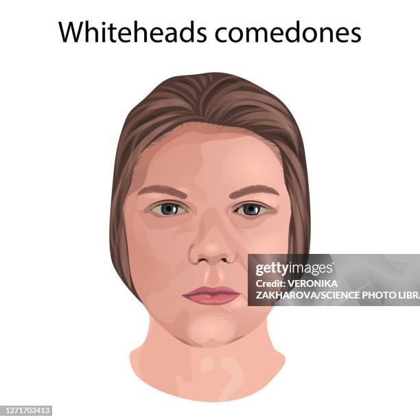ilustraciones, imágenes clip art, dibujos animados e iconos de stock de whitehead comedones, illustration - acné