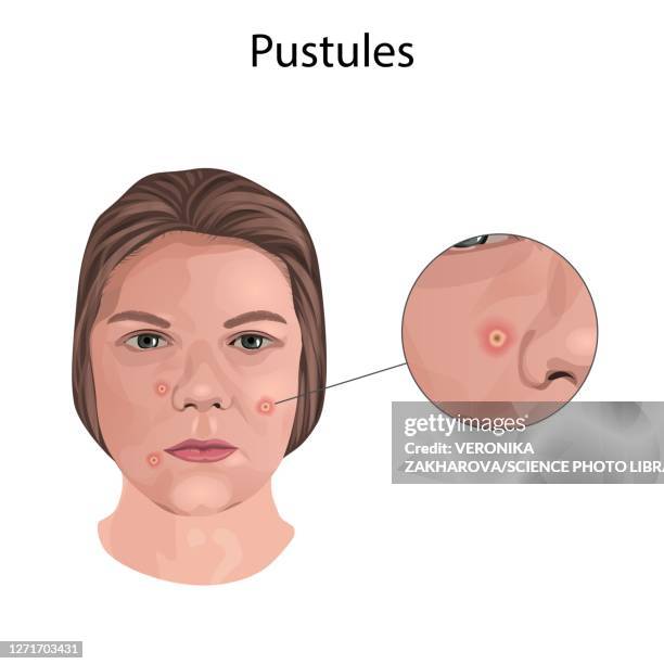 Exploding Pustules 72 Pustules Stock Photos, High-Res Pictures, and Images - Getty Images