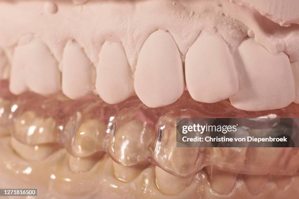 professional splint on plaster model - bruxism stock pictures, royalty-free photos & images