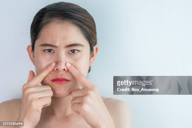 portrait of asian woman pointing acne and aging scar problem occur on her face. - blackheads on face stock pictures, royalty-free photos & images