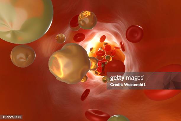 three dimensional render of artery clogged by cholesterol - atherosklerose stock-grafiken, -clipart, -cartoons und -symbole