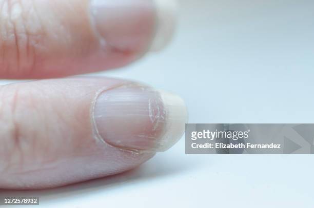 close-up of brittle nails. damage to the nails after using polish. peeling on the nails. damage to the nail. shattered nails. - nagelhaut stock-fotos und bilder