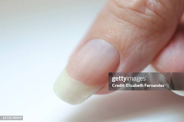 close-up of brittle nails. damage to the nails after using polish. peeling on the nails. damage to the nail. shattered nails. - cutícula fotografías e imágenes de stock