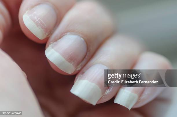 close-up of brittle nails. damage to the nails after using polish. peeling on the nails. damage to the nail. shattered nails. - haut empfindlich stock-fotos und bilder