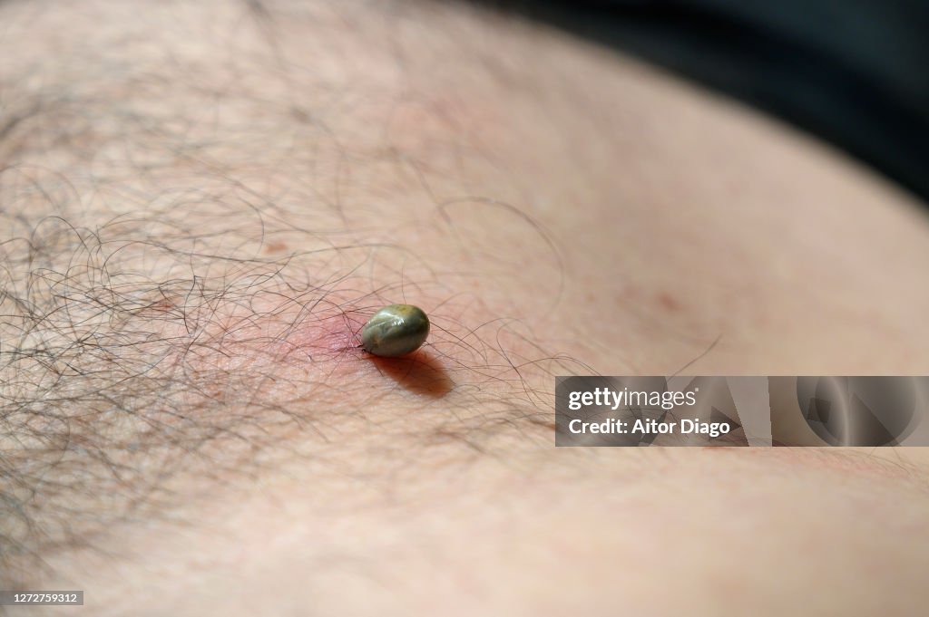 Tick ​​attached to the skin of a man's stomach and sucking blood. Germany