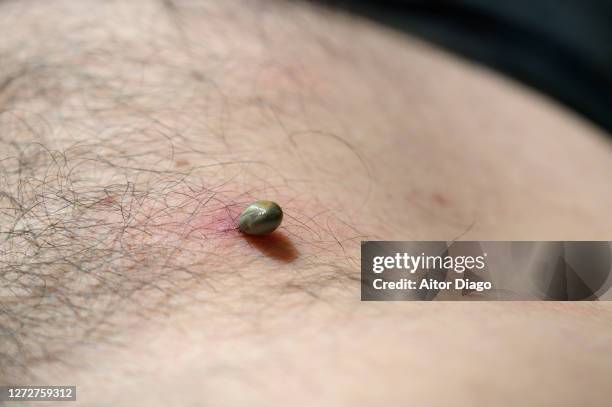 tick ​​attached to the skin of a man's stomach and sucking blood. germany - insect bites images - fotografias e filmes do acervo