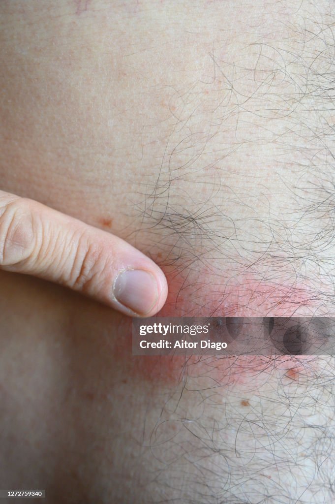 Infected tick bite on a man's stomach. Germany