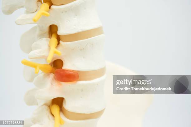spine - ankylosing spondylitis stock pictures, royalty-free photos & images