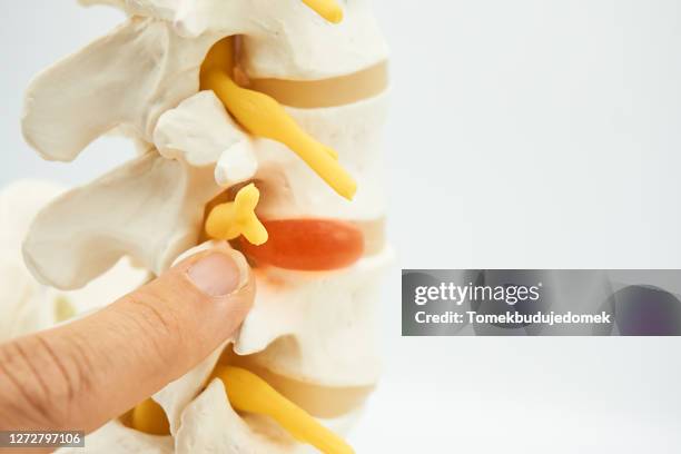 spine - herniated disc 個照片及圖片檔