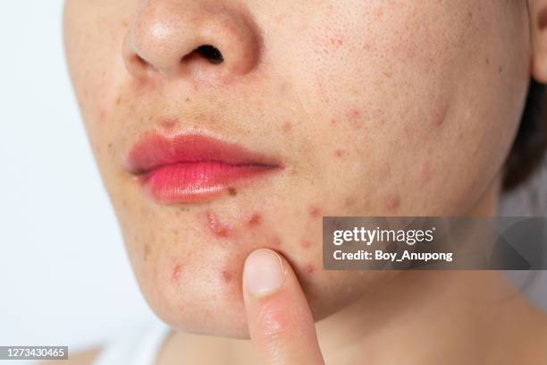 close-up of woman half face with problems of acne inflammation (papule and pustule) and scar occur on her face. - blackheads photos et images de collection