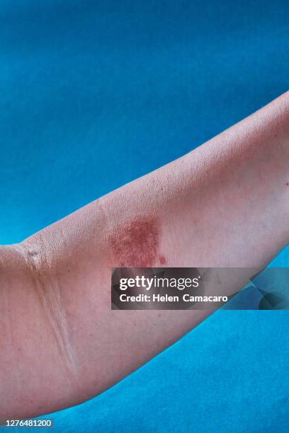 woman arm wit second degree burn on an arm - burn injury fotografías e imágenes de stock