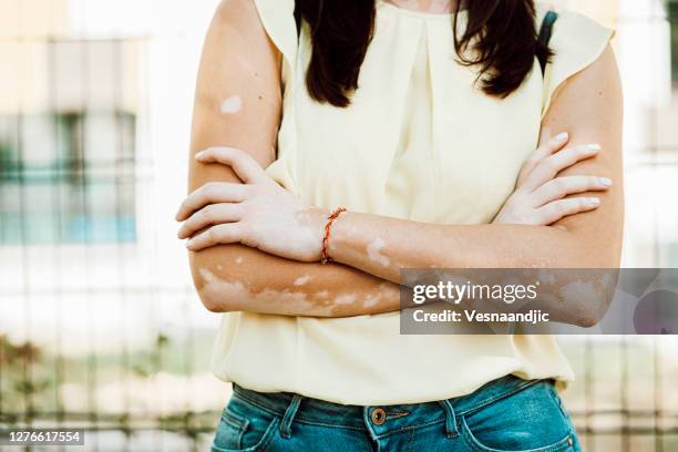 close up of beautiful junge frau mit hautproblemen - vitiligo stock-fotos und bilder
