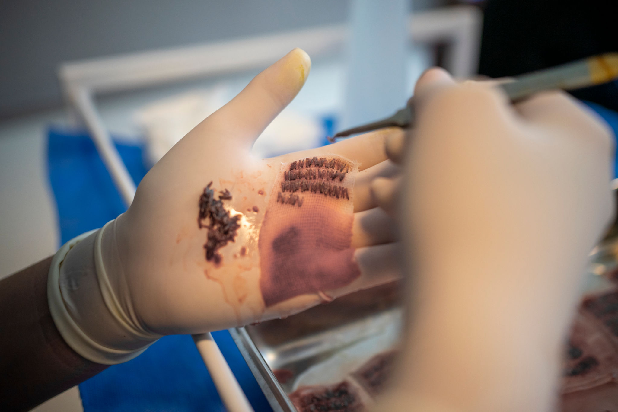 women hair transplant