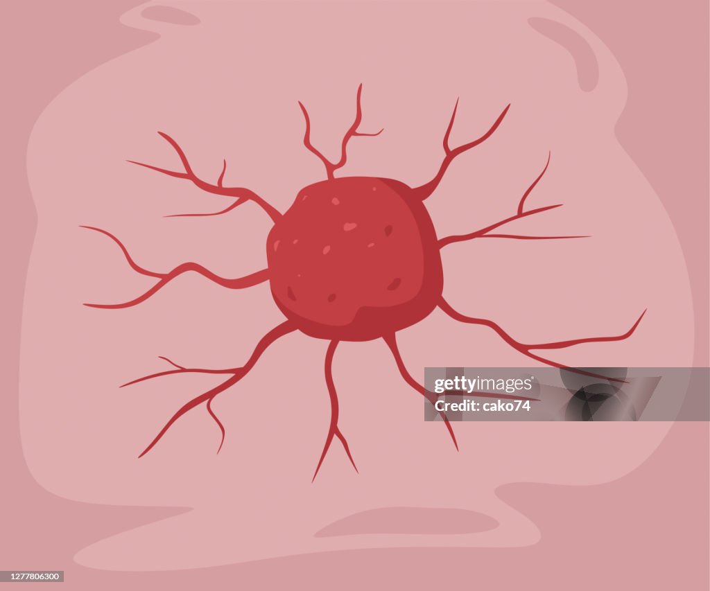 Ilustración de stock de tumor