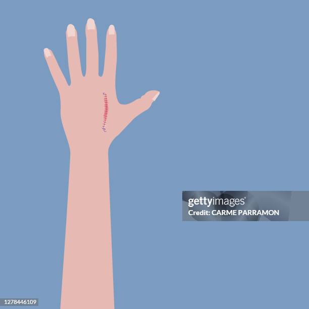 ilustrações, clipart, desenhos animados e ícones de ferida costurada com rosca na mão. curar a lesão - hand laceration