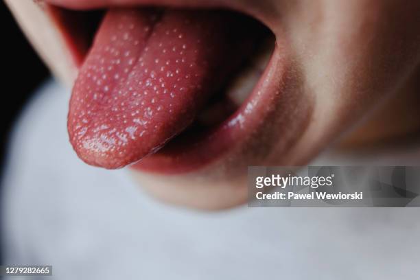 boy with scarlet fever - sticking out tongue stock pictures, royalty-free photos & images