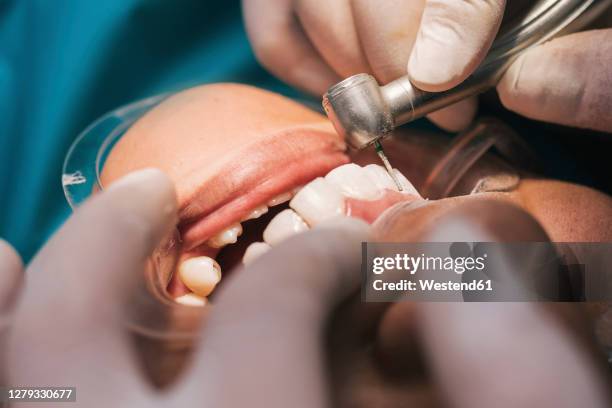 mouth of female patient during orthodontic procedure - tandartsboor stockfoto's en -beelden