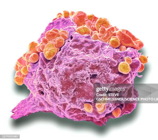 lymphoma cancer cell, sem - lymphoma stock pictures, royalty-free photos & images