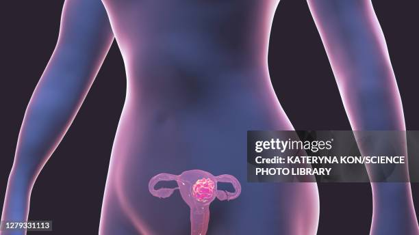 uterine cancer, conceptual illustration - ovary stock-grafiken, -clipart, -cartoons und -symbole