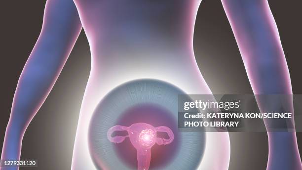 ilustraciones, imágenes clip art, dibujos animados e iconos de stock de uterine cancer, conceptual illustration - ovarios