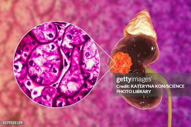 kidney cancer, illustration and light micrograph - light micrograph stock illustrations