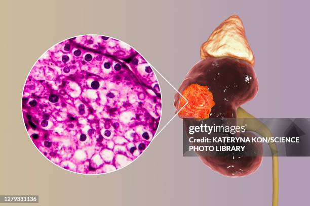 kidney cancer, illustration and light micrograph - 光学顕微鏡図点のイラスト素材／クリップアート素材／マンガ素材／アイコン素材