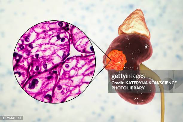 kidney cancer, illustration and light micrograph - light micrograph stock illustrations